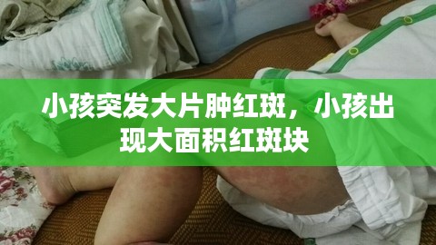 小孩突发大片肿红斑，小孩出现大面积红斑块 