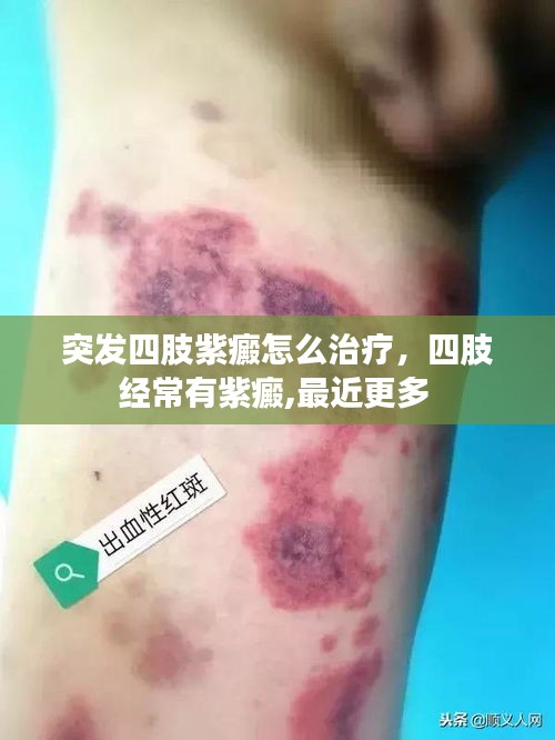 突发四肢紫癜怎么治疗，四肢经常有紫癜,最近更多 