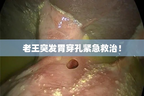 老王突发胃穿孔紧急救治！